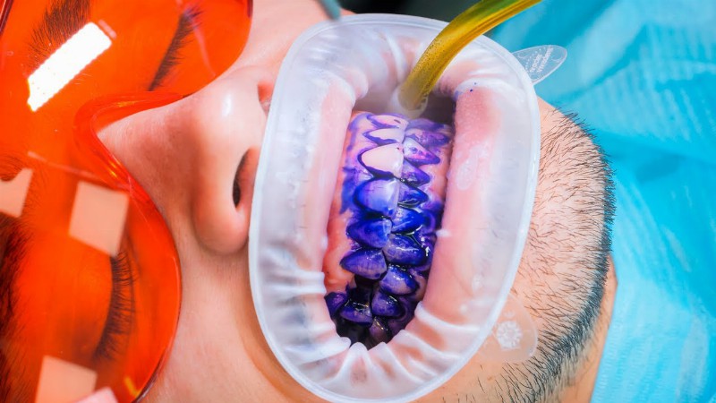 image 0 Deep Cleaning Of Dirty Teeth 🦷 Professional Dental Care & Jewelry For Teeth